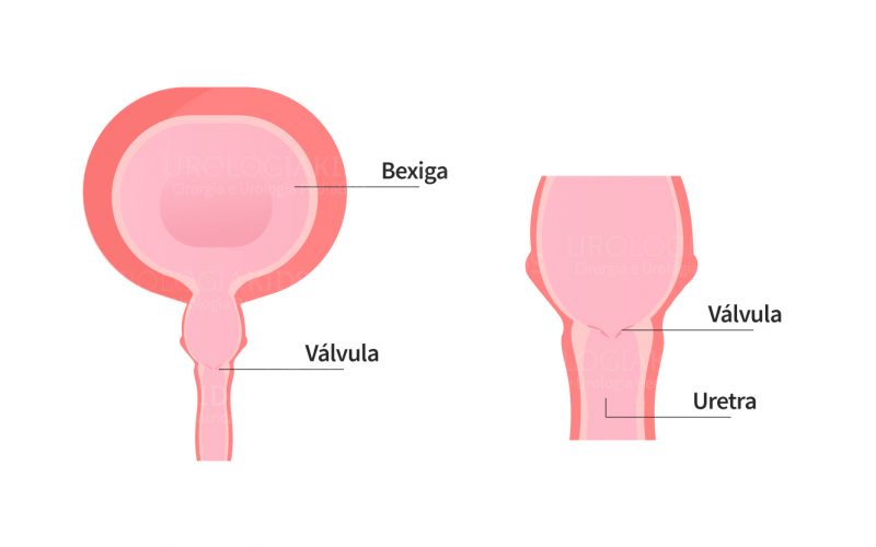 Válvula de uretra posterior